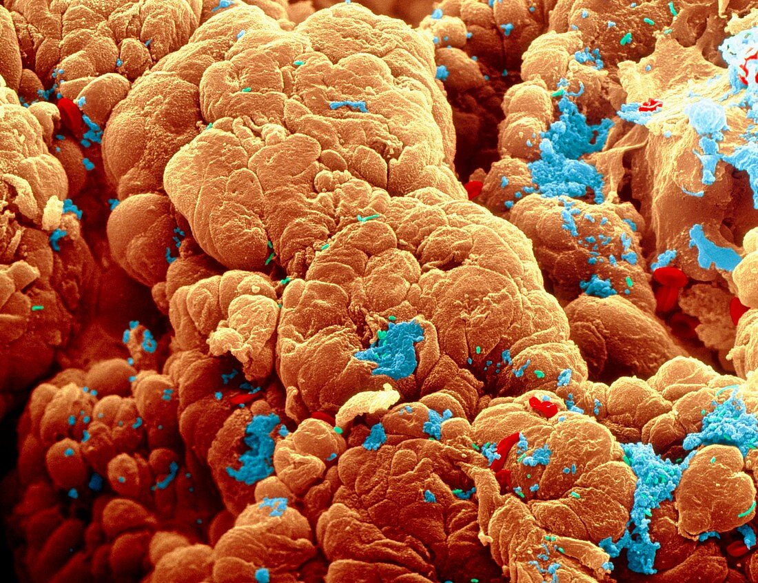 Coloured SEM of cancer of the colon.