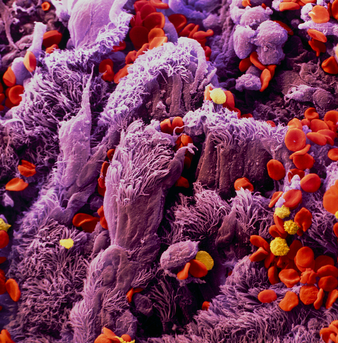 Colour SEM of lung bronchus epithelium with cancer
