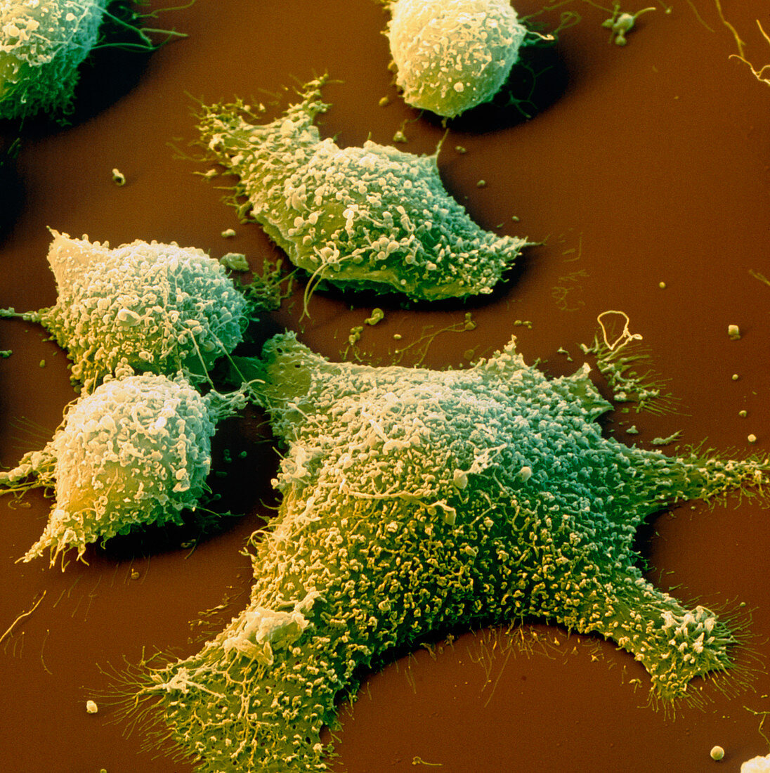 Coloured SEM of cancer cells from the colon
