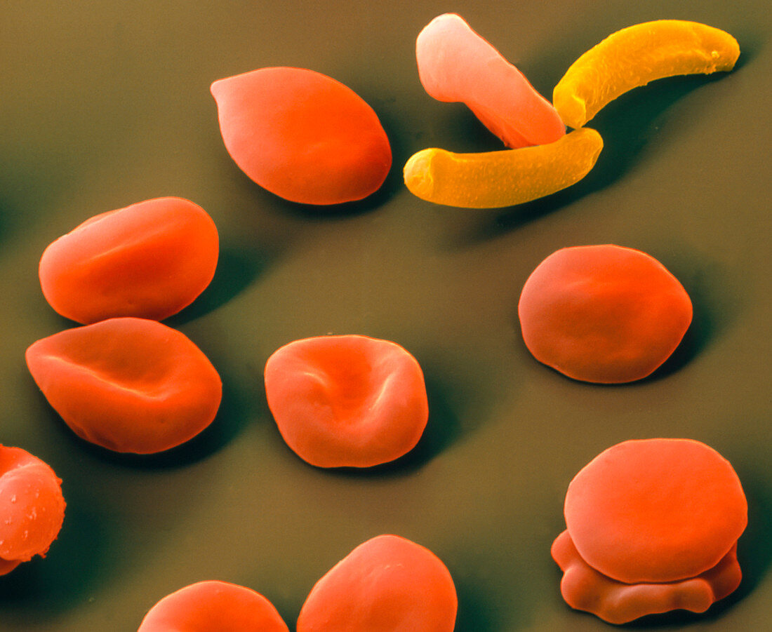 SEM of red blood cells with Plasmodium