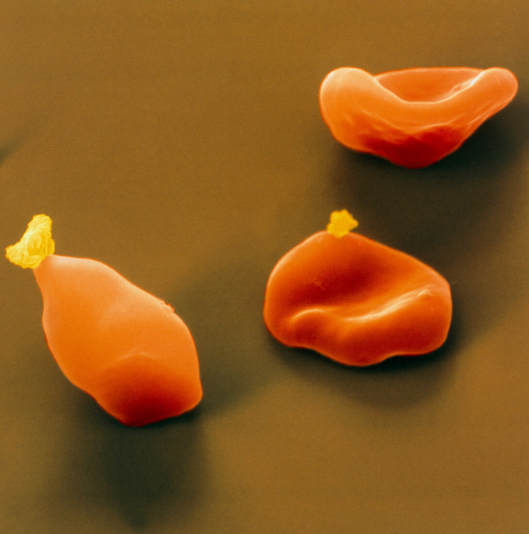 Coloured SEM of red blood cells with Plasmodium
