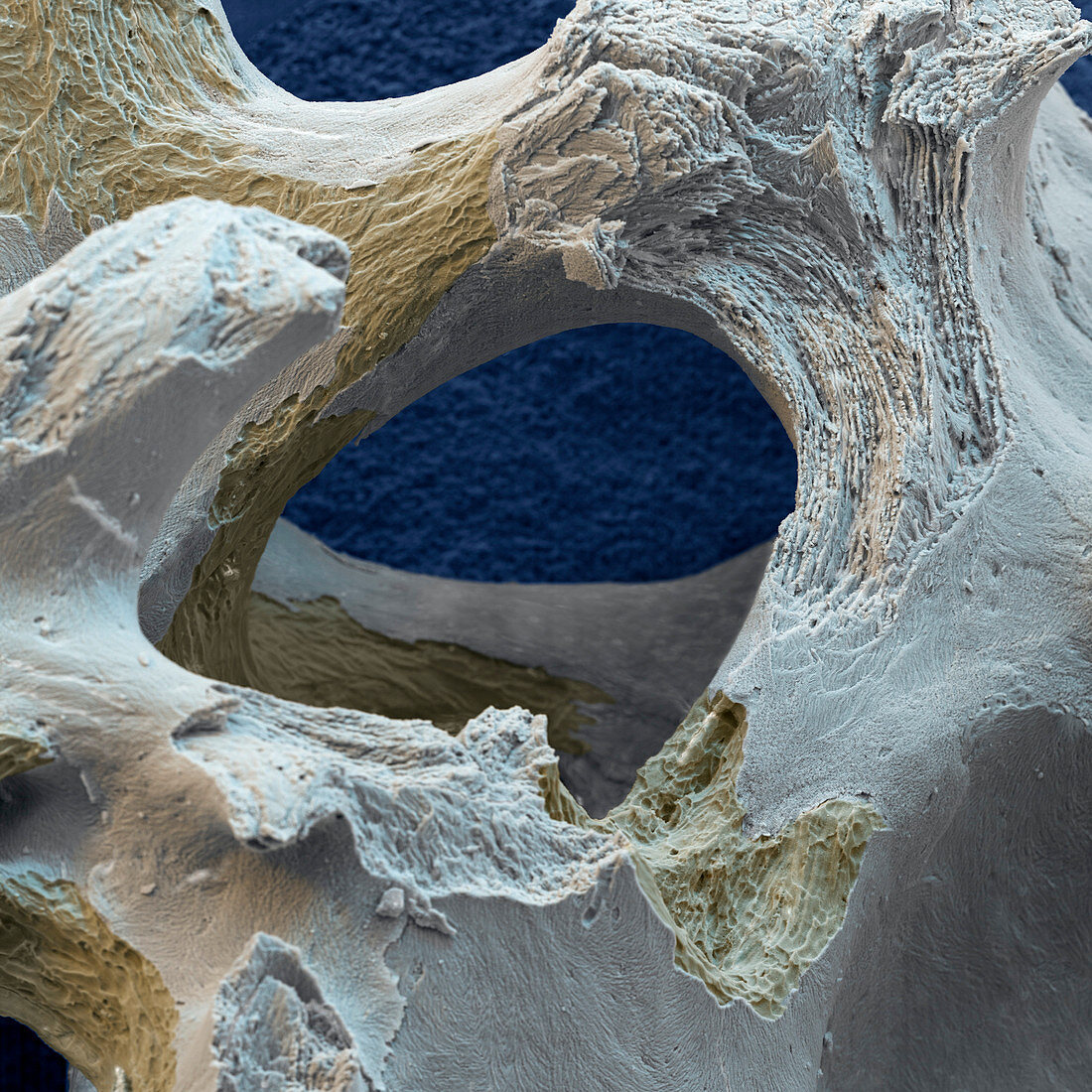 Knochen Osteoporose 120x - 