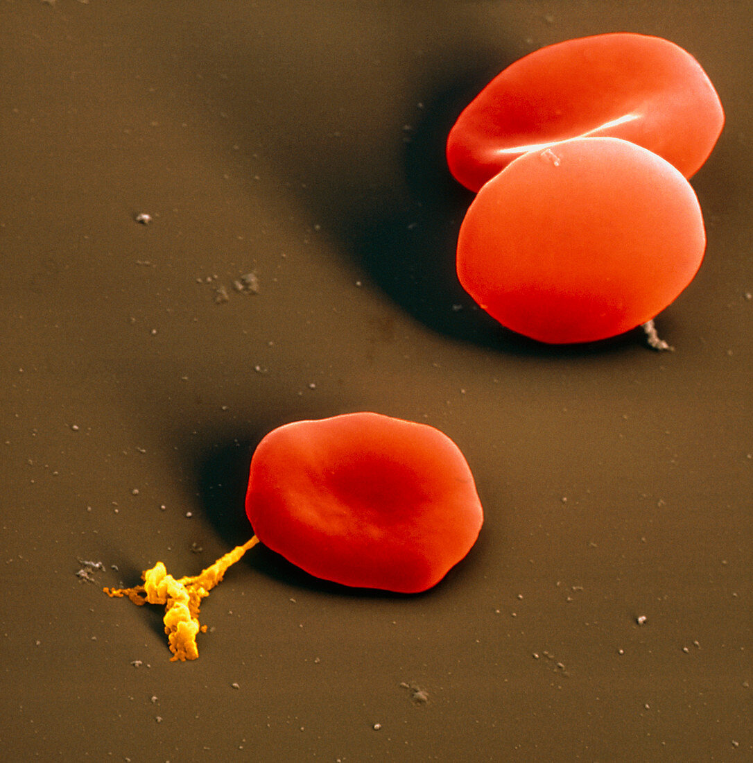 Coloured SEM of red blood cells and a platelet