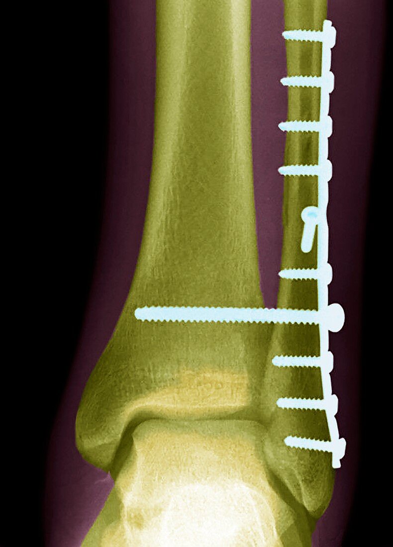 Ankle fracture, X-ray