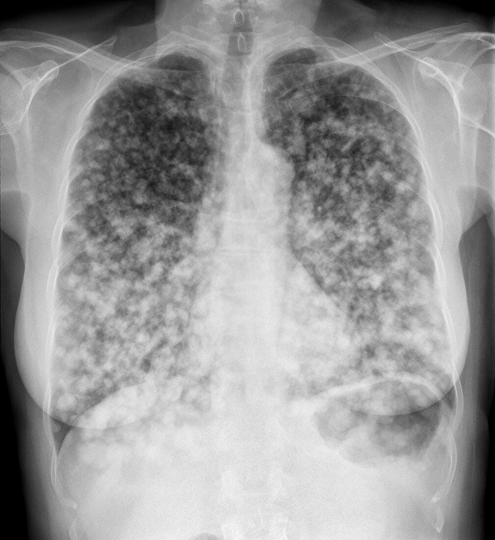 Secondary lung cancer, X-ray