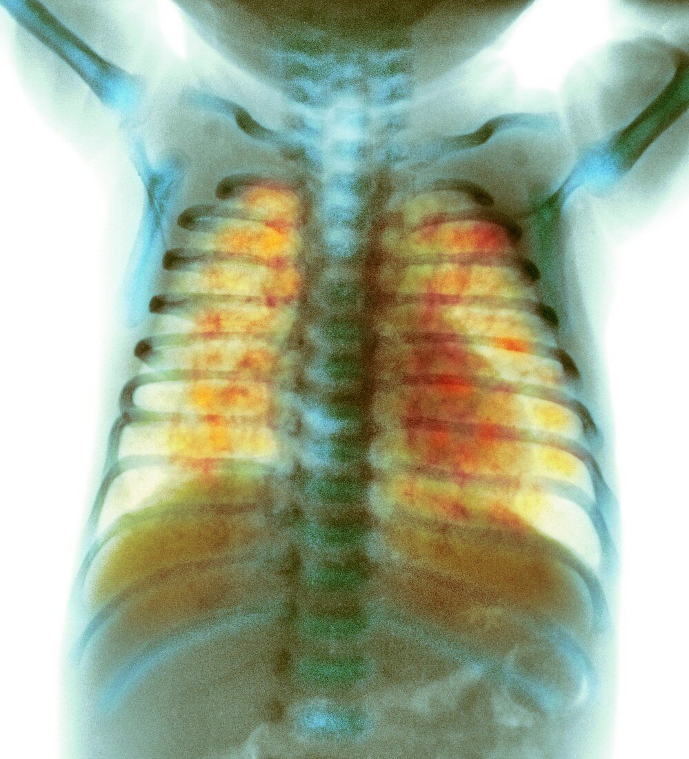 Wilson-Mikity syndrome, X-ray