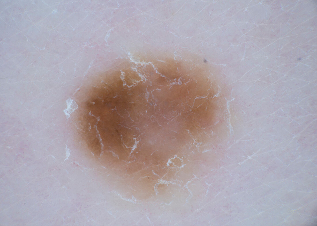 Mole diagnosis, dermascope image