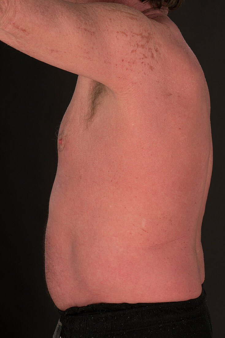 Atopic dermatitis and eczema herpeticum