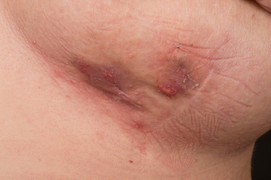 Hidradenitis suppurativa of the breasts