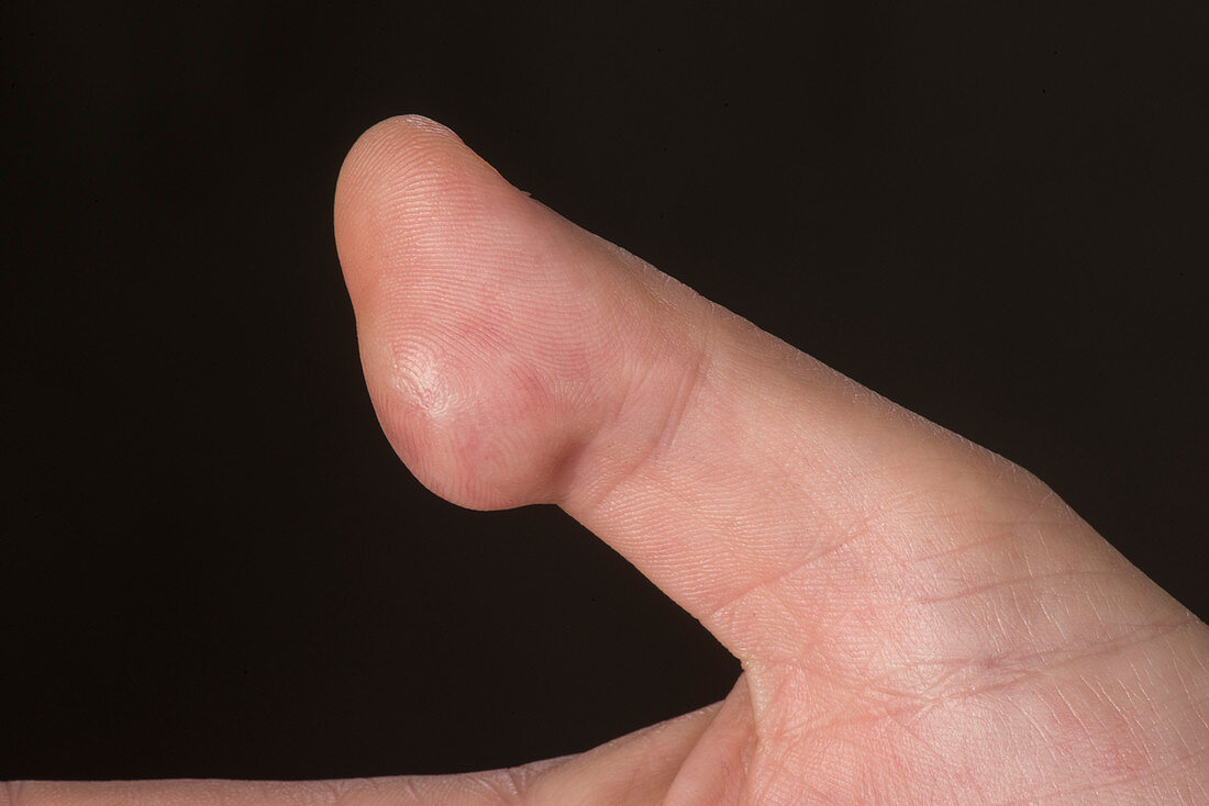 Hidradenitis suppurativa of the thumb