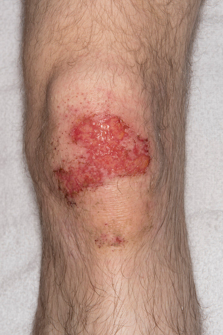 Chemical cement burn on knee