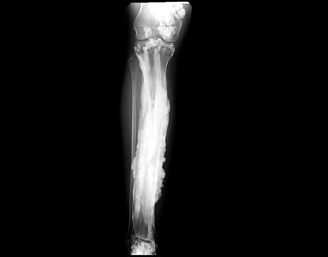 Melorheostosis of the lower leg, X-ray