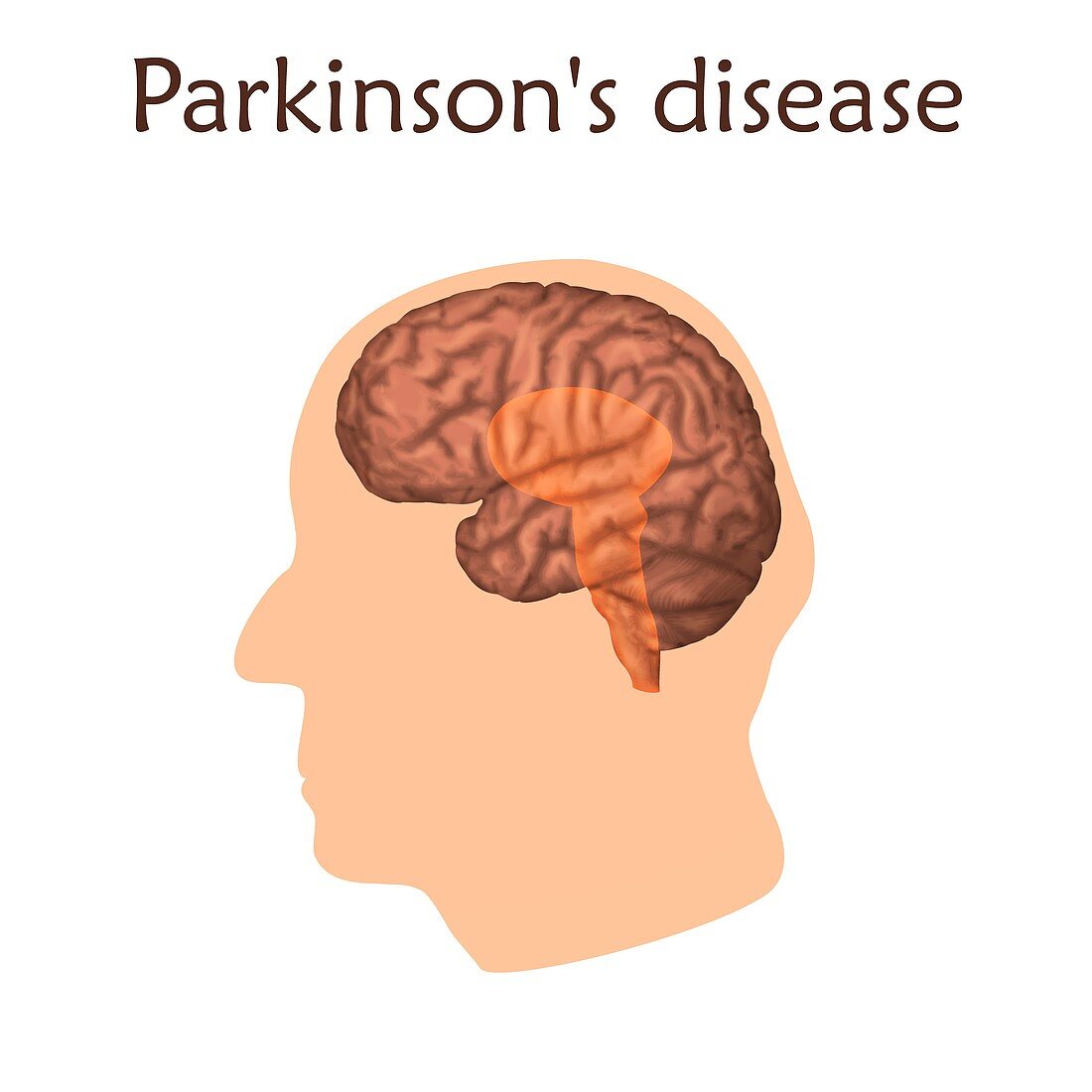 Parkinson's disease, illustration