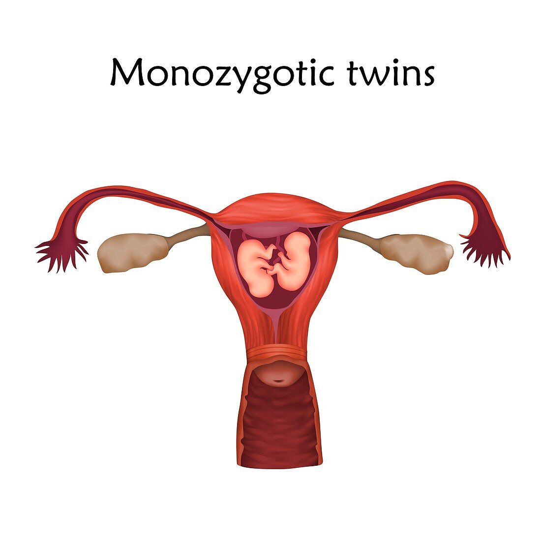 Monozygotic twins, illustration