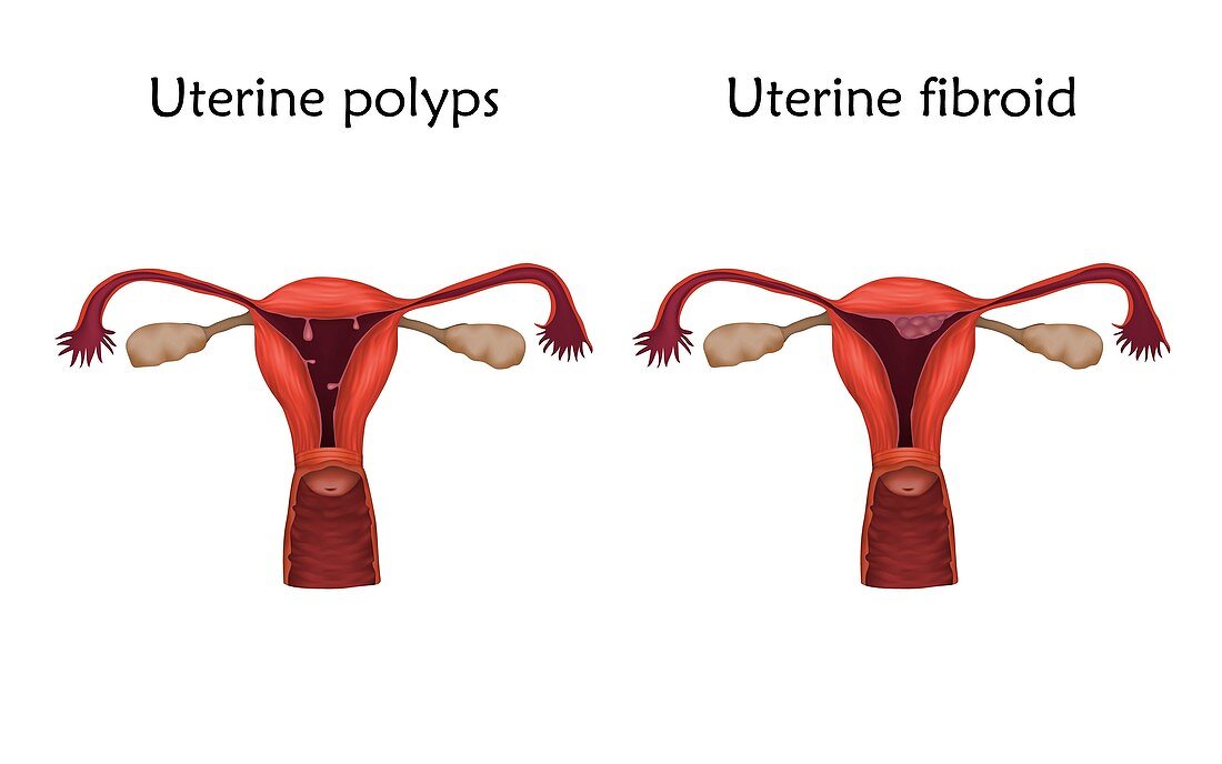 Uterine polyps and uterine fibroid, illustration