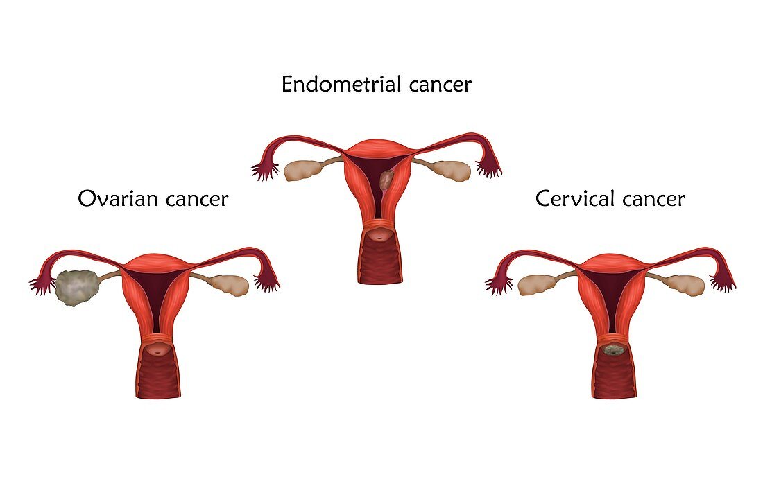 Reproductive system cancers, illustration