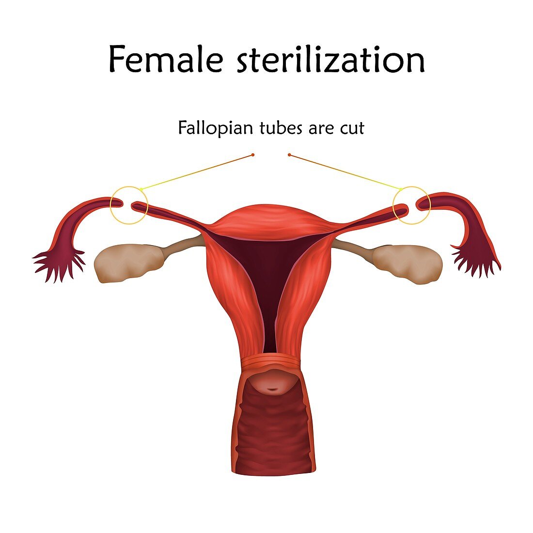 Female sterilization, illustration