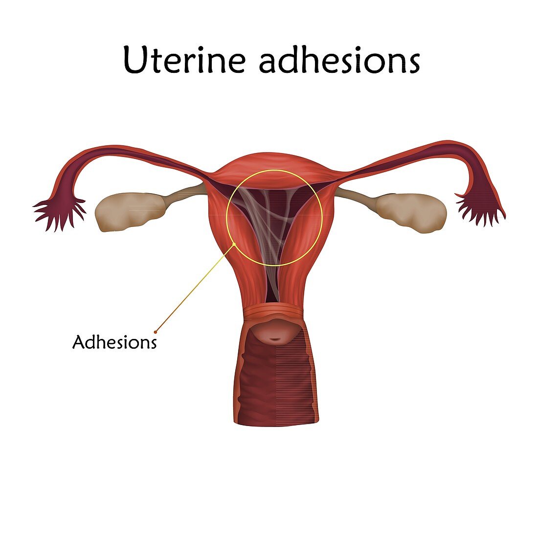 Uterine adhesions, illustration