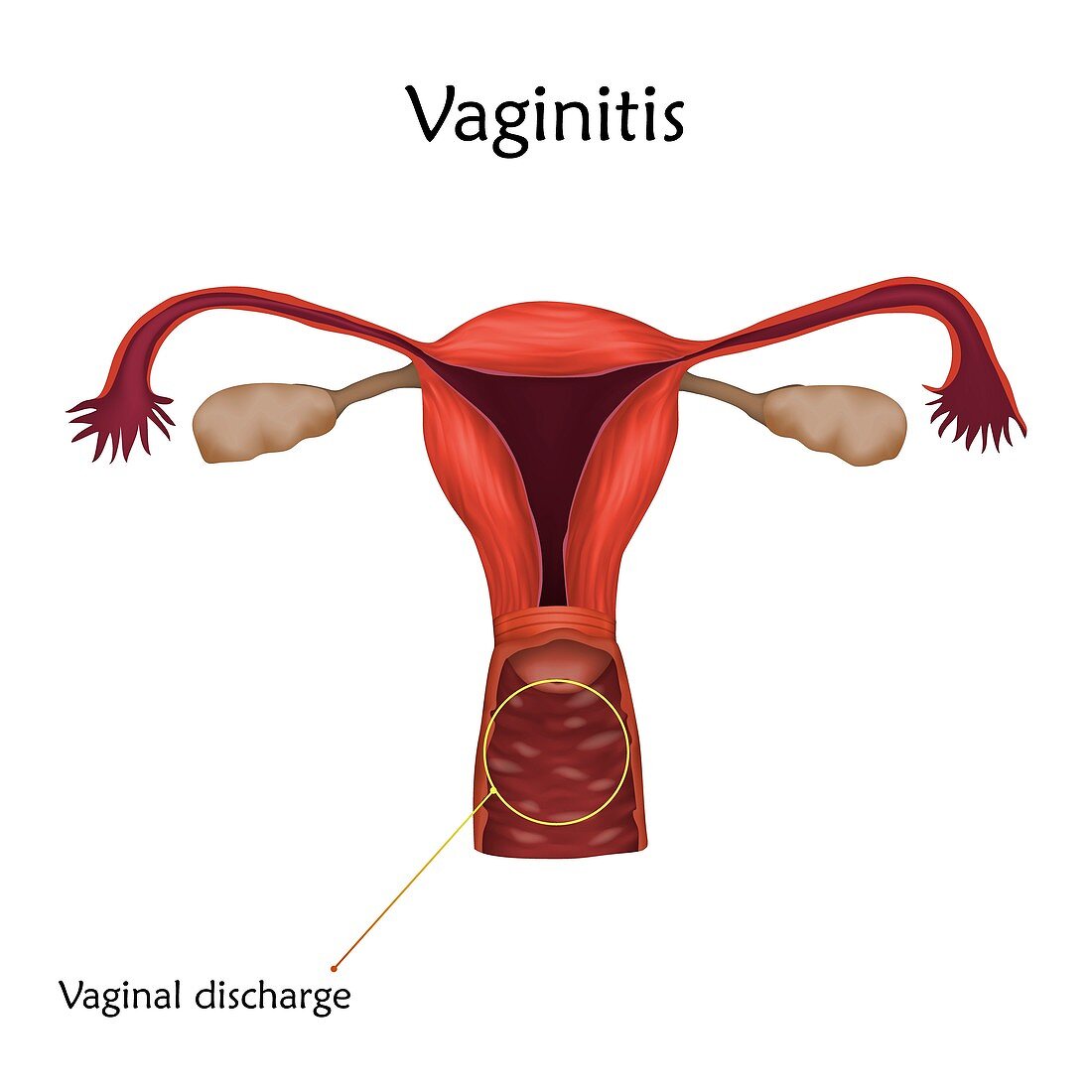 Vaginitis, illustration