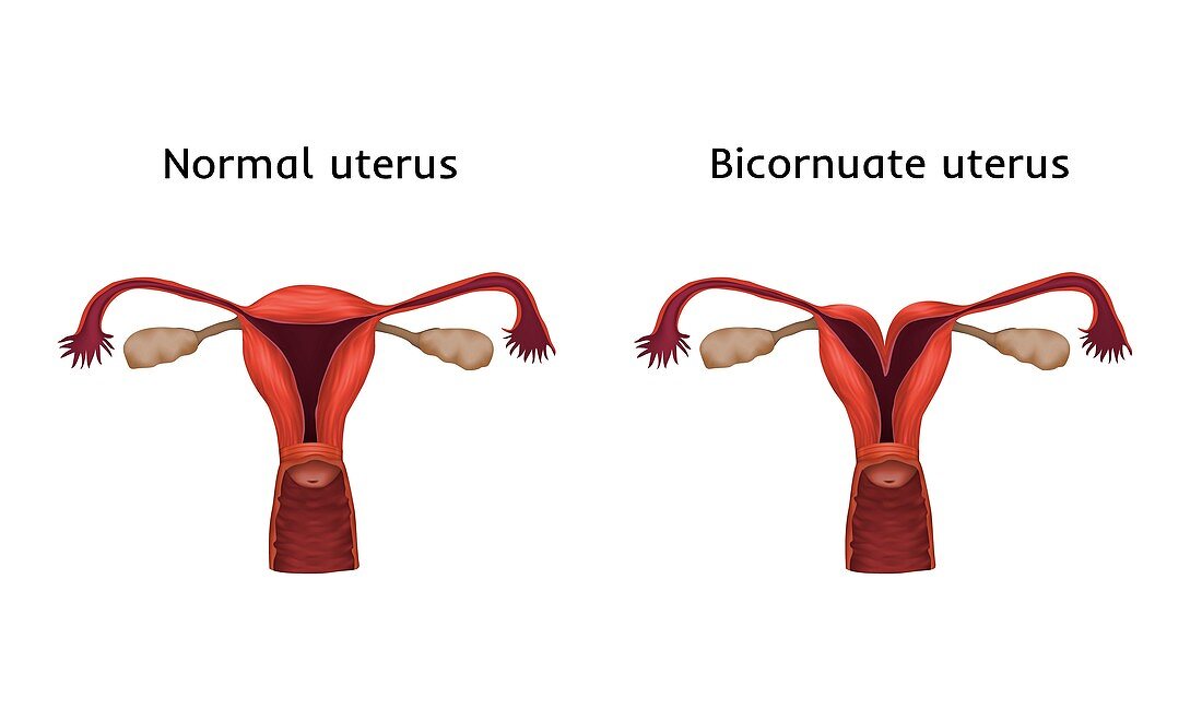 Bicornuate and normal uterus, illustration