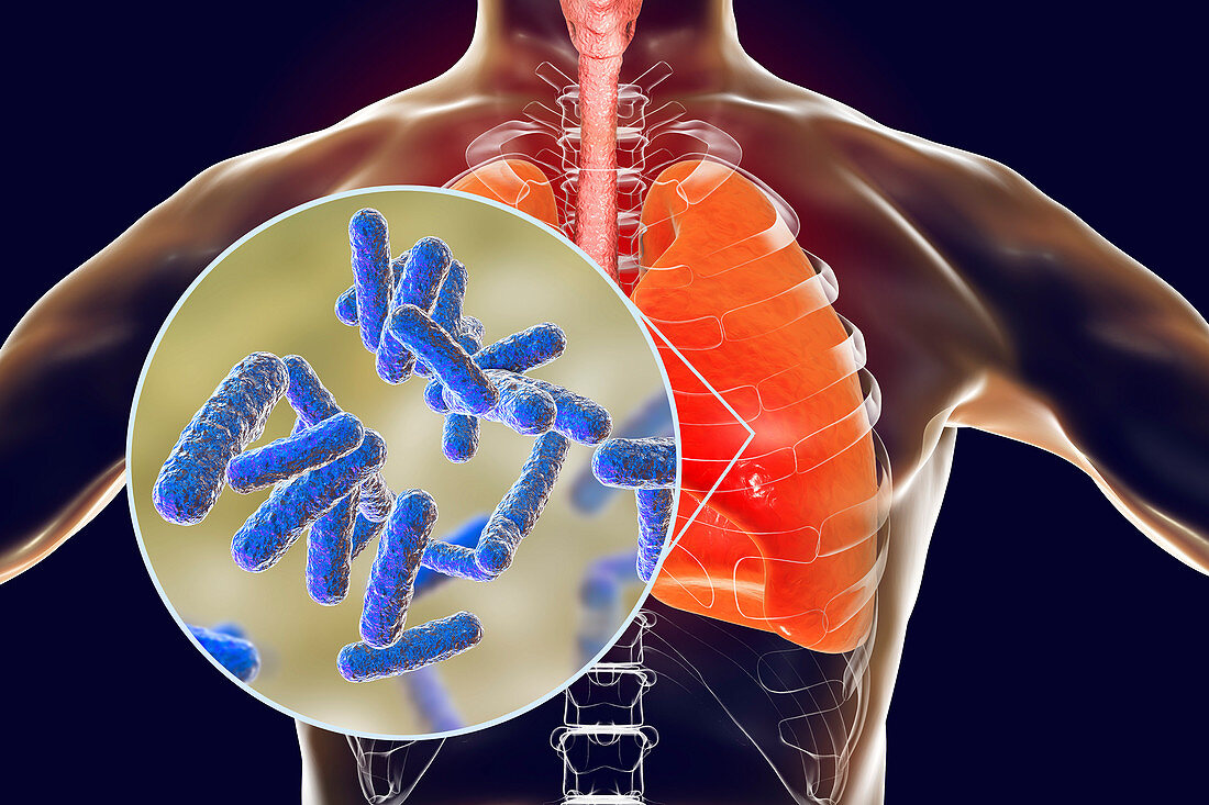 Bacterial pneumonia, conceptual illustration