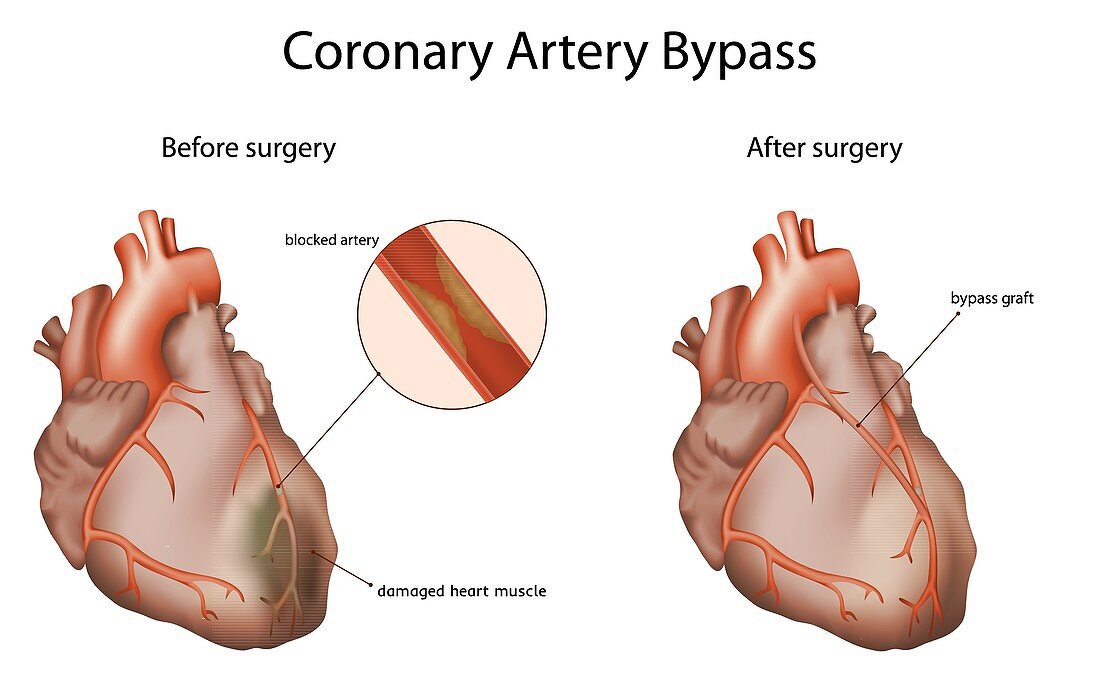 Coronary artery bypass, illustration