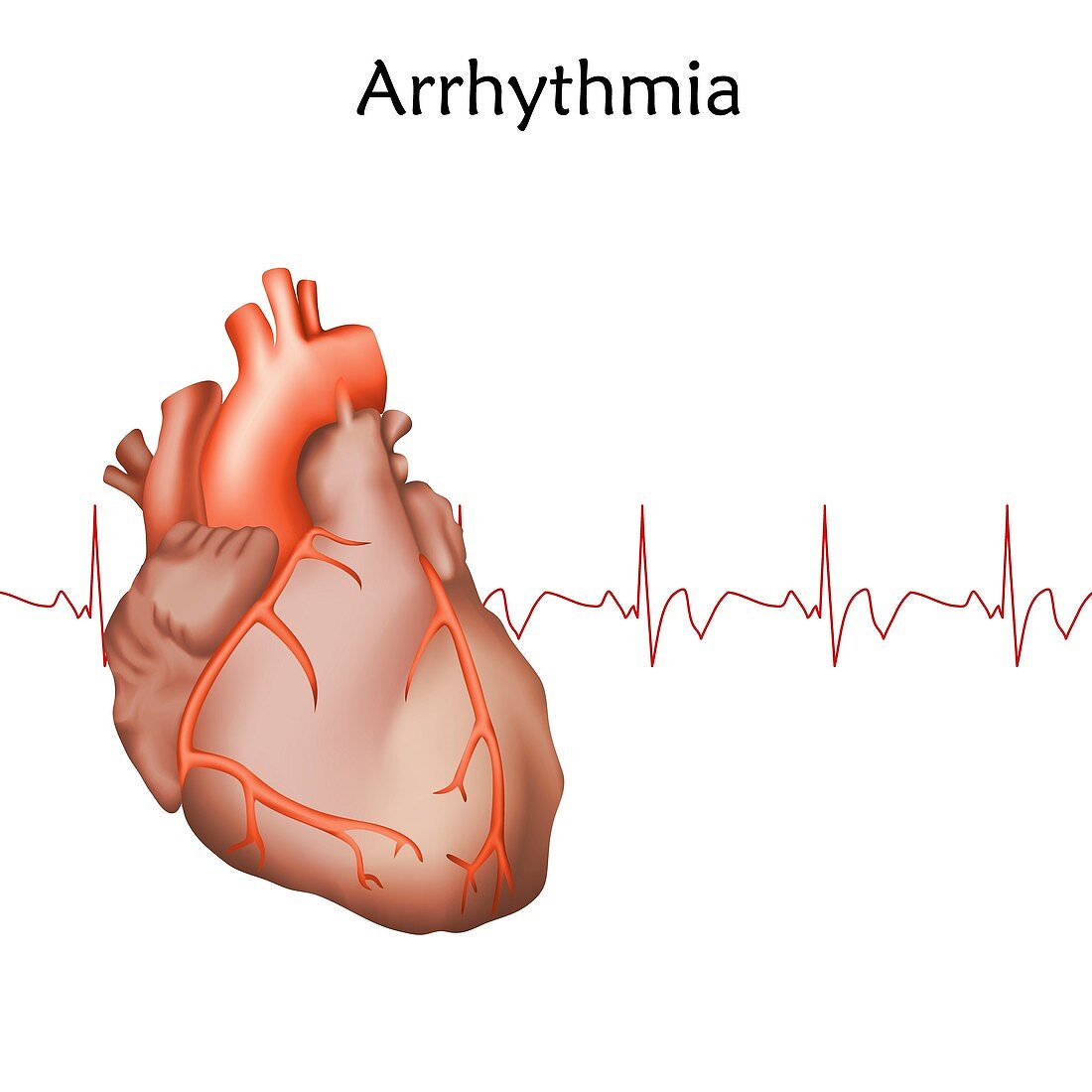 Heart arrhythmia, illustration