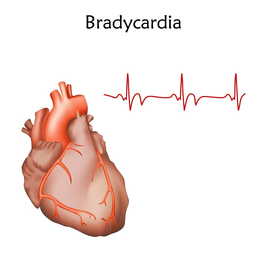 Bradycardia, illustration