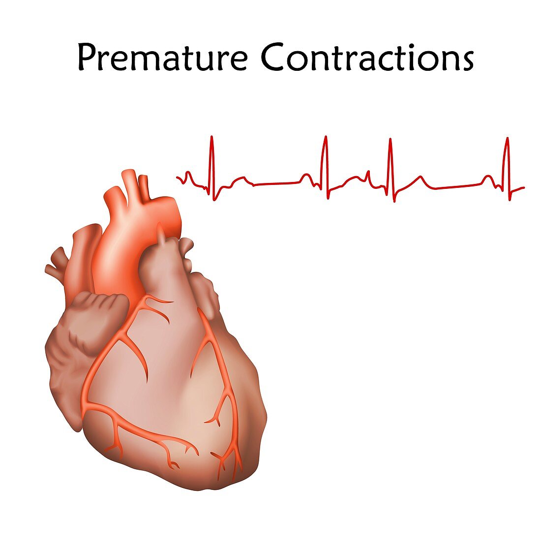 Premature heart contractions, illustration
