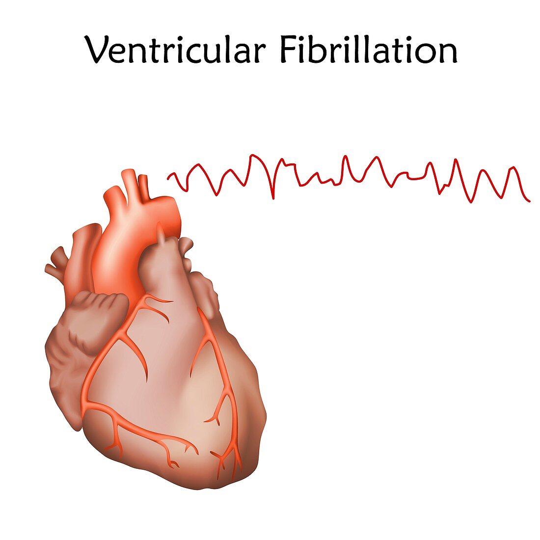 Ventricular fibrillation, illustration