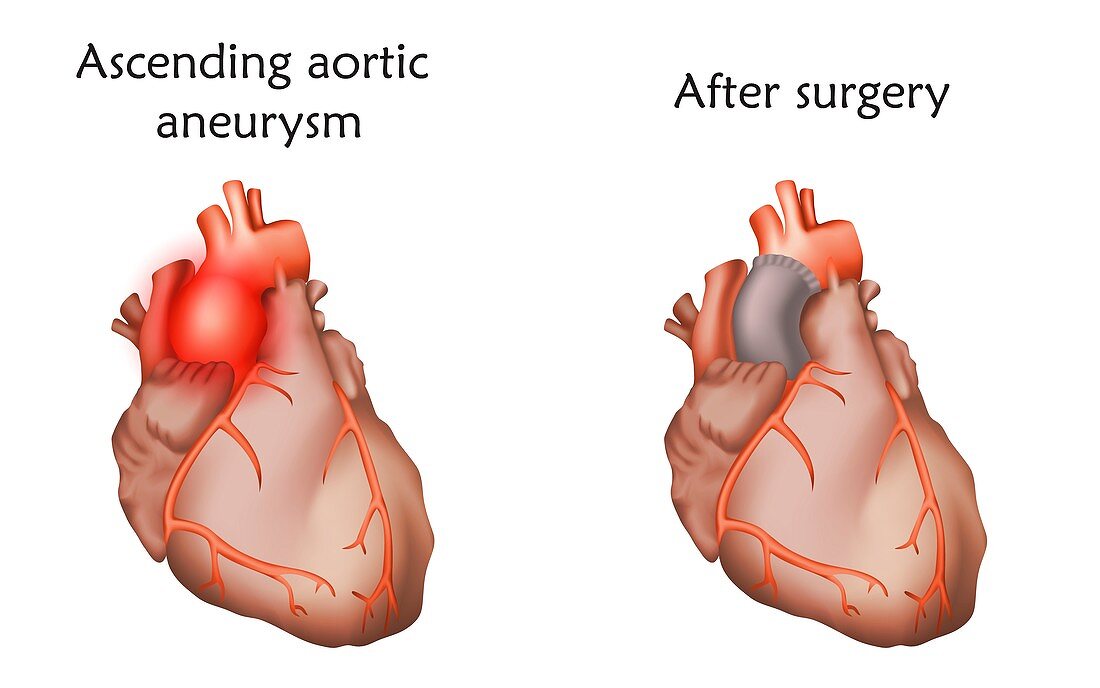 Ascending aortic aneurysm treatment, illustration