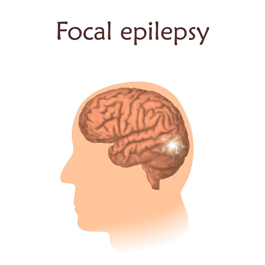 Focal epilepsy, illustration
