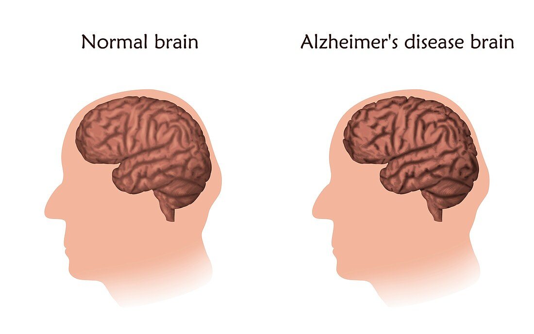 Alzheimer's disease, illustration