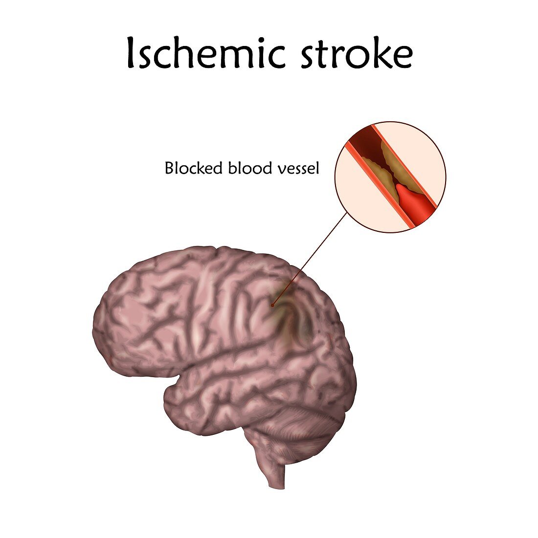 Ischemic stroke, illustration