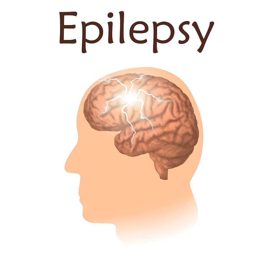 Epilepsy, illustration