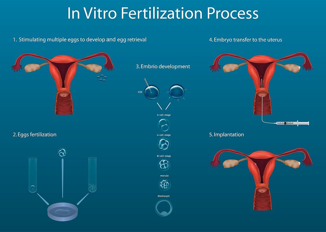 In vitro fertilization process, illustration
