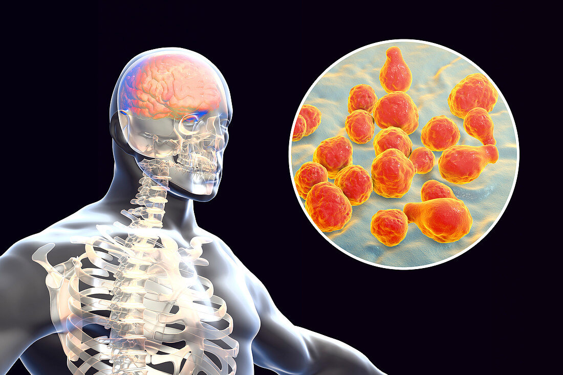 Fungal meningitis, illustration