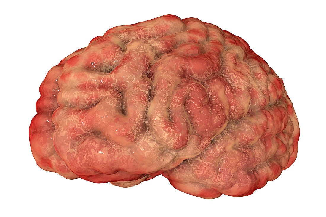 Brain with encephalitis, illustration