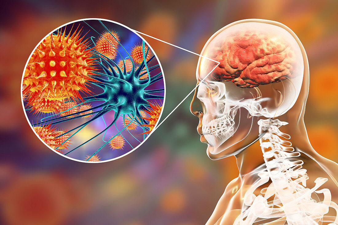 Viral encephalitis, illustration