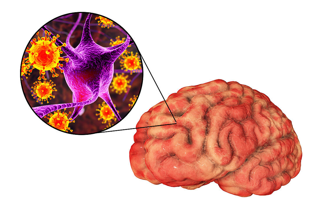 Viral encephalitis, illustration