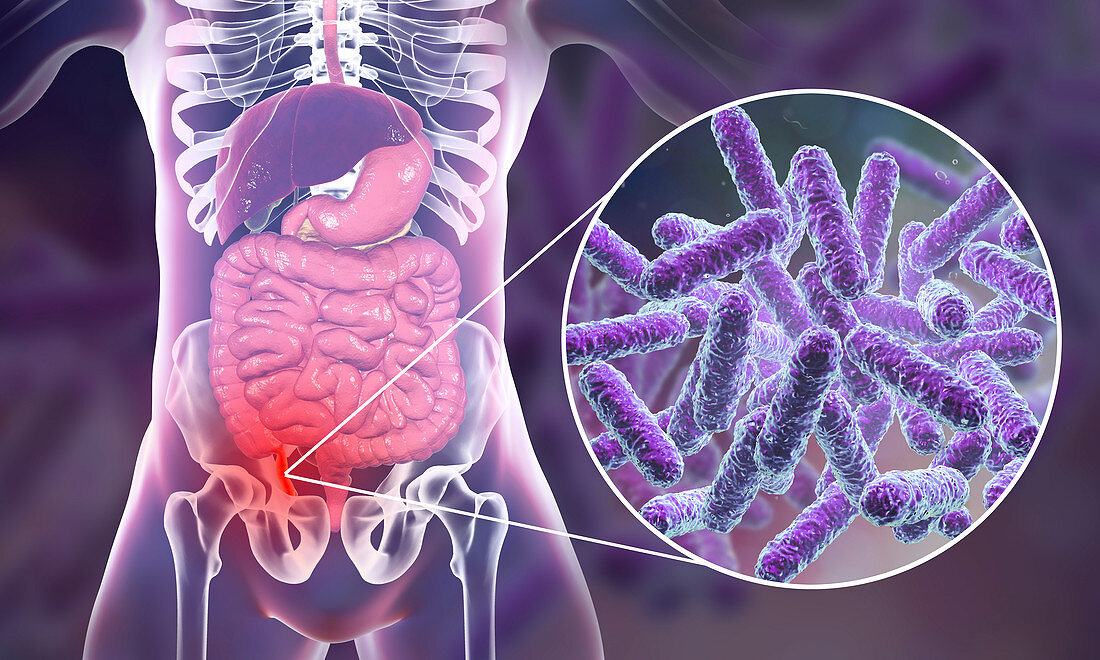 Appendicitis, illustration