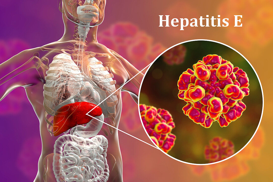 Hepatitis E infection, illustration