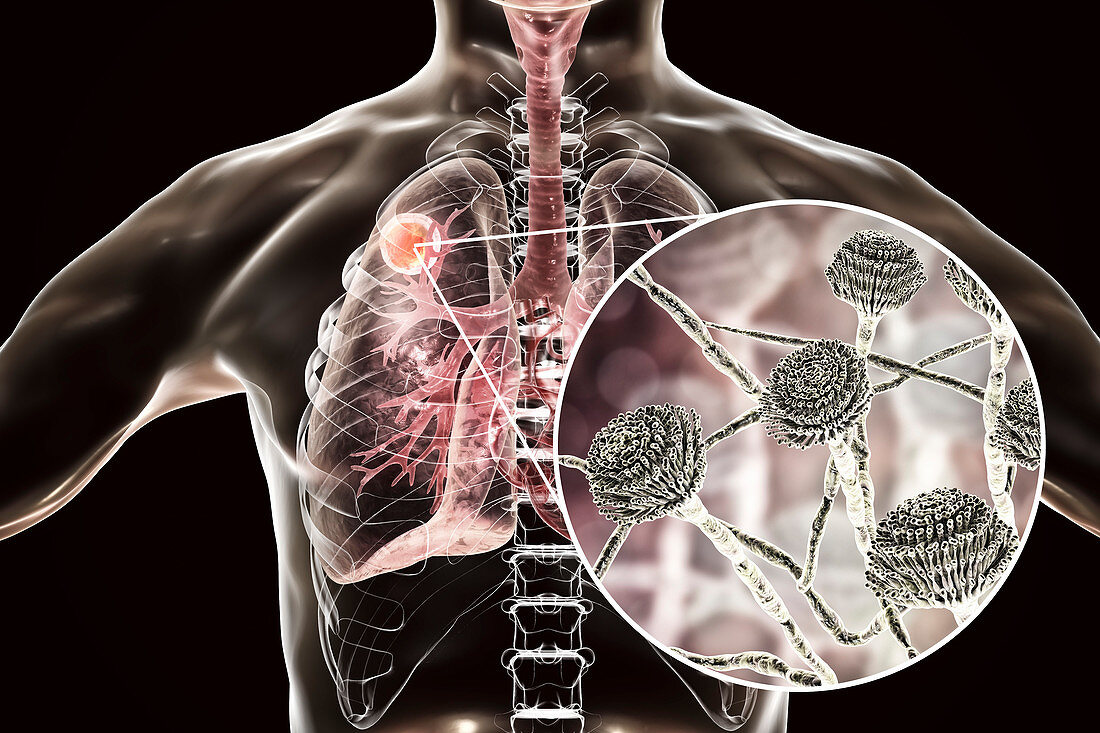 Aspergilloma of the lung, illustration