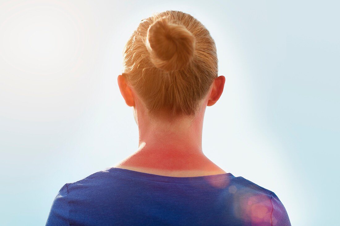 Woman with sunburnt neck