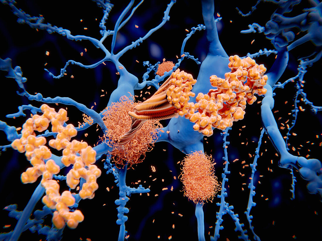 Amyloid protein in Alzheimer's disease, illustration