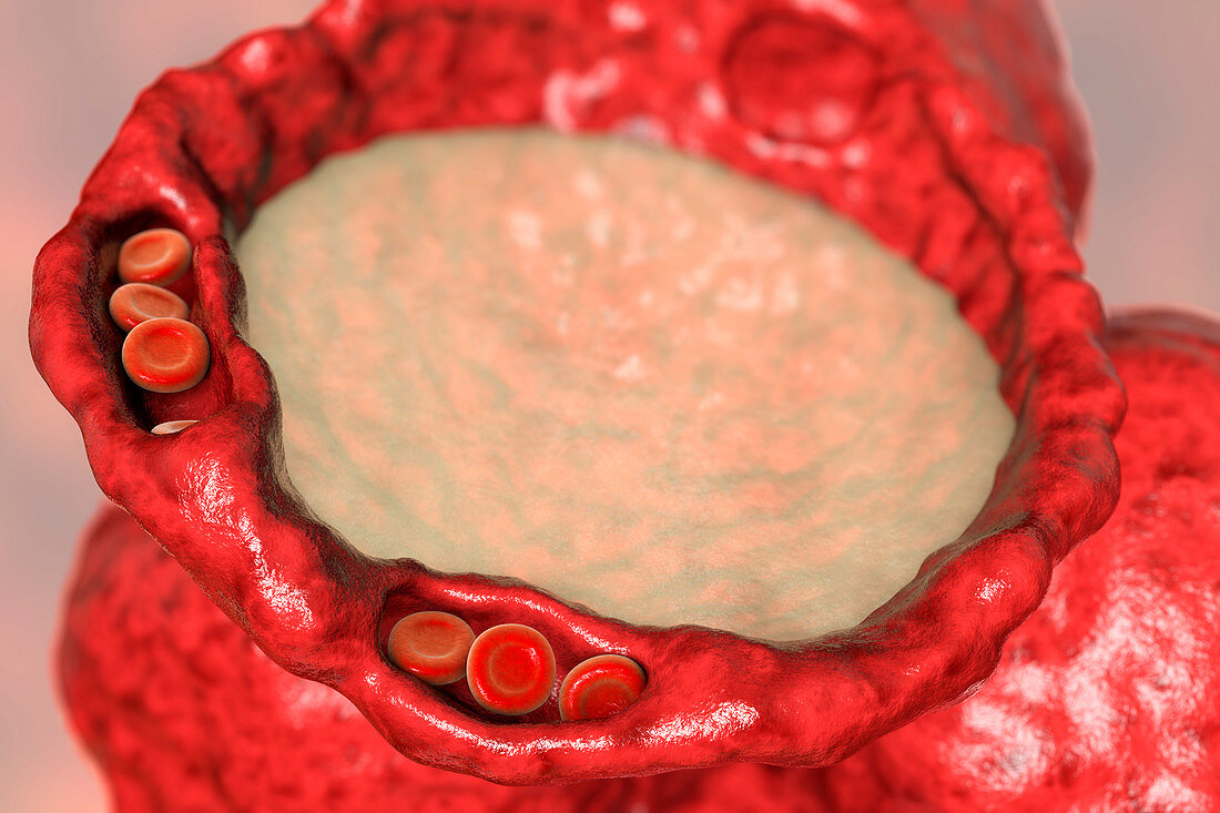 Pulmonary edema, illustration