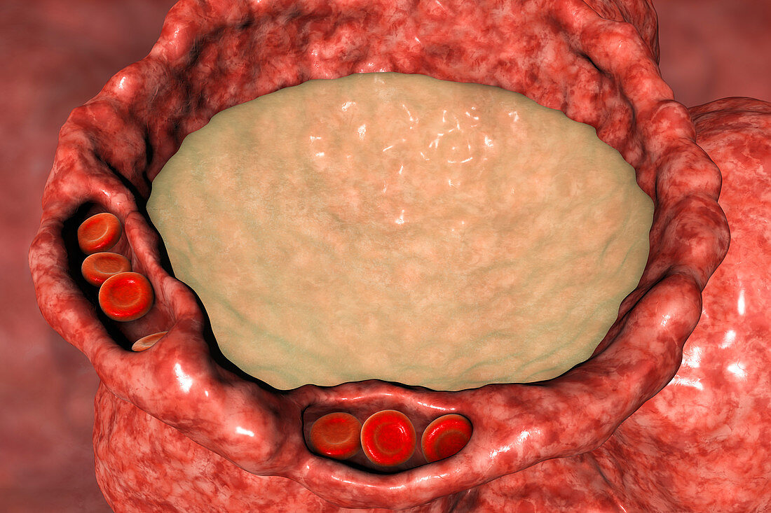 Pulmonary edema, illustration