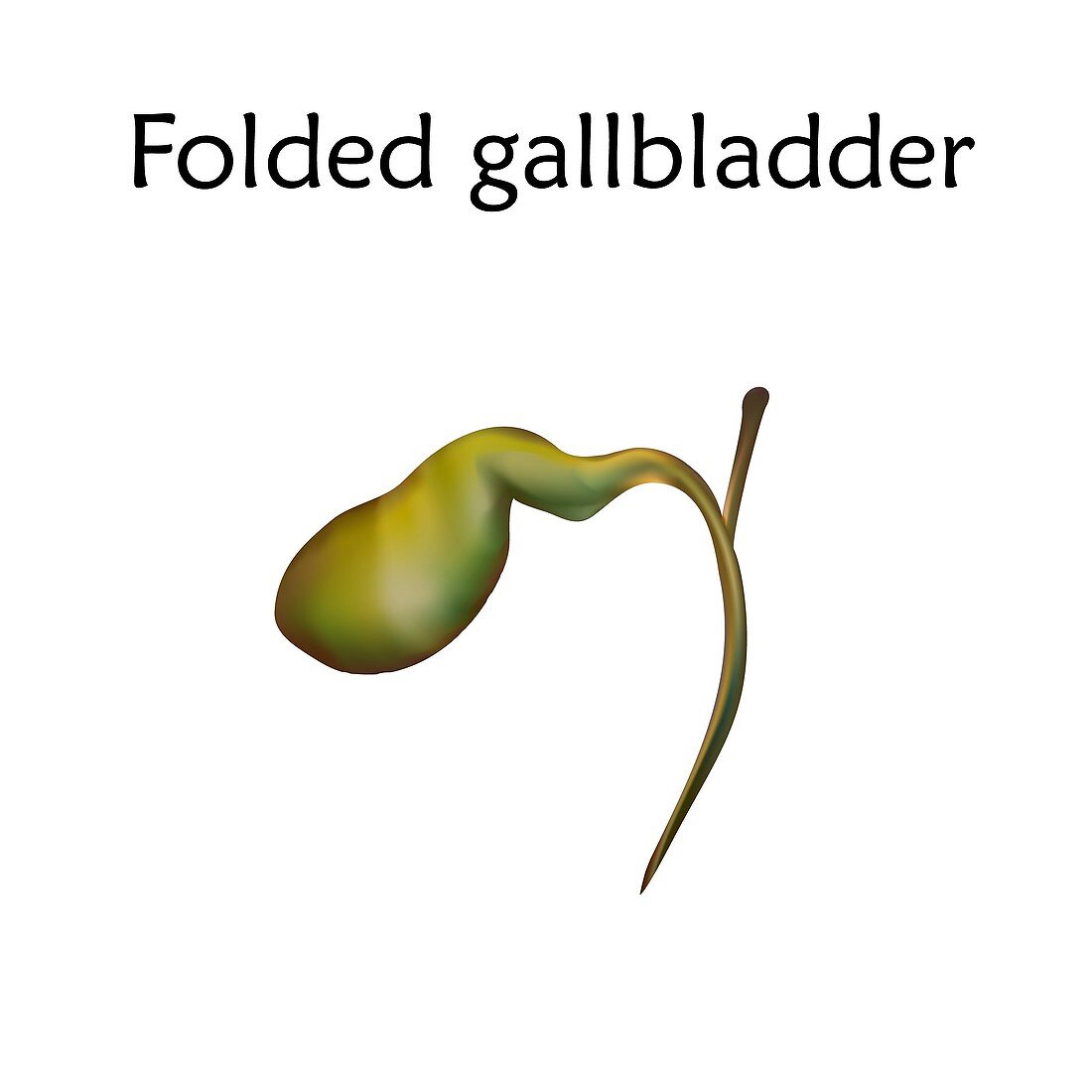 Folded gallbladder, illustration