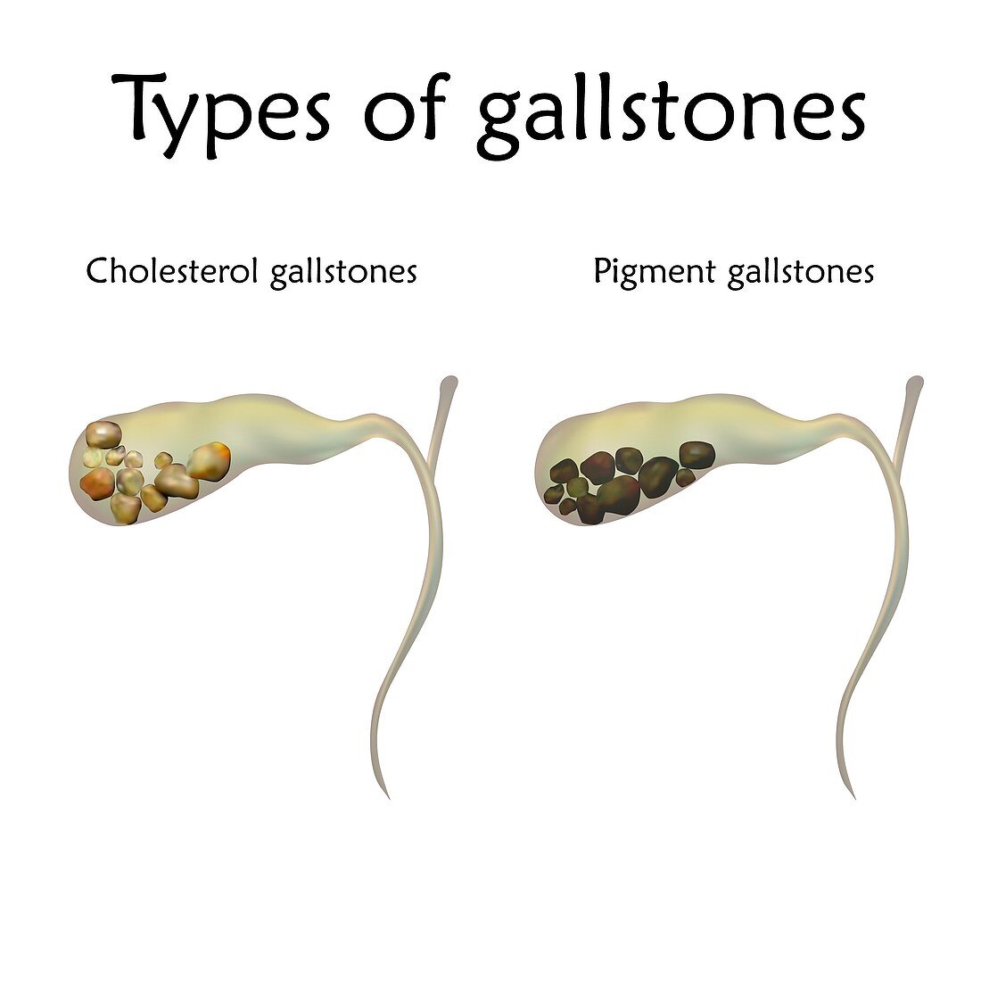 Types of gallstones, illustration