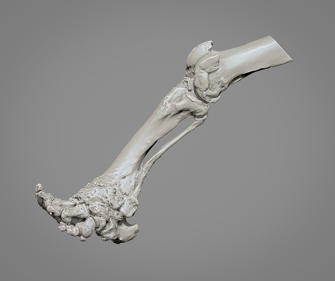 Arthritic elephant leg, 3D CT scan
